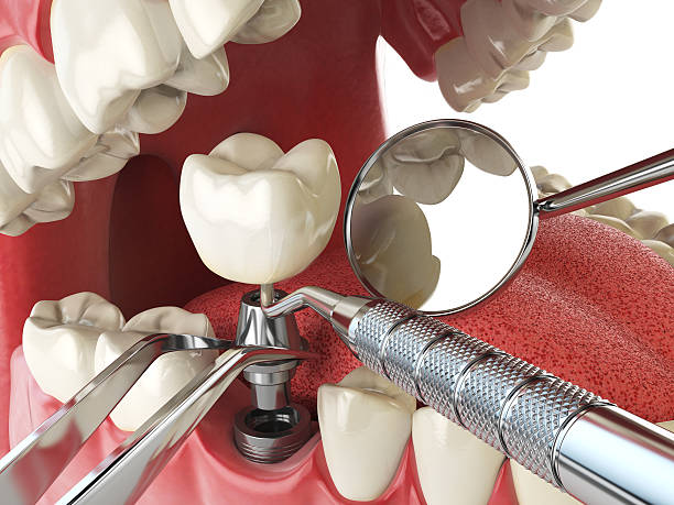 Best Emergency Root Canal Treatment in Lincoln, ID